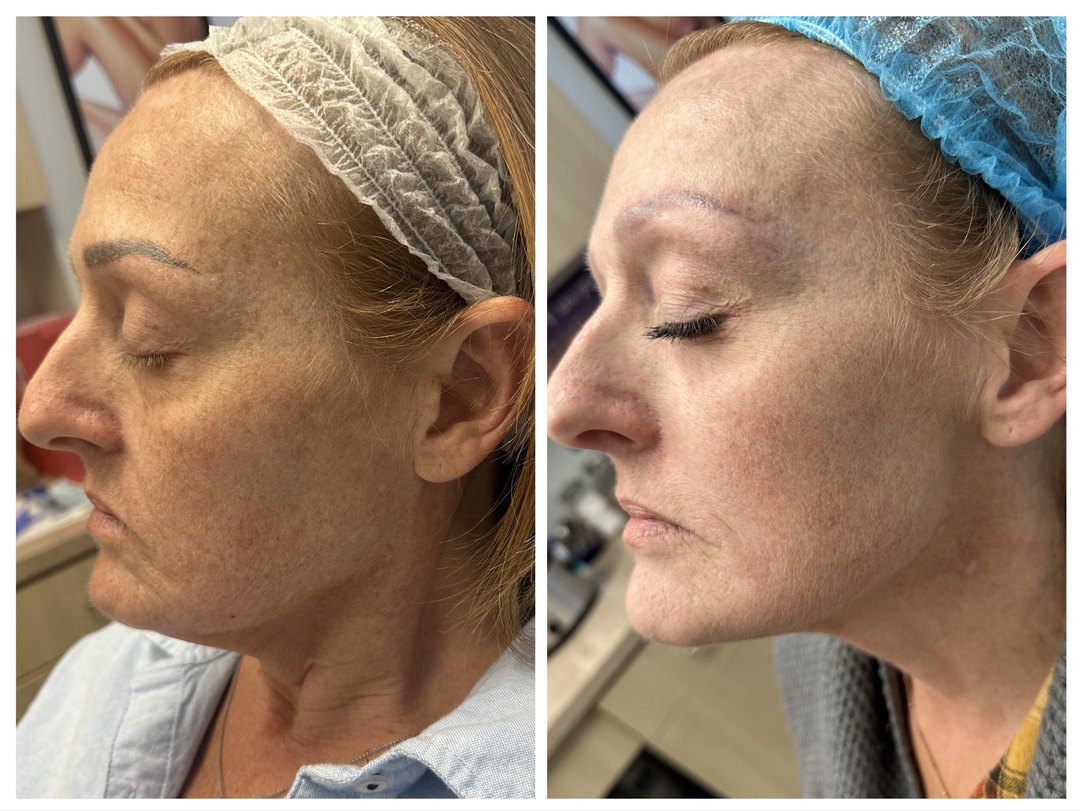 Before and after CO2 skin resurfacing microneedling with peptides Epionce Lux facial and chemical peels at Tu Es Belle Spa Houston