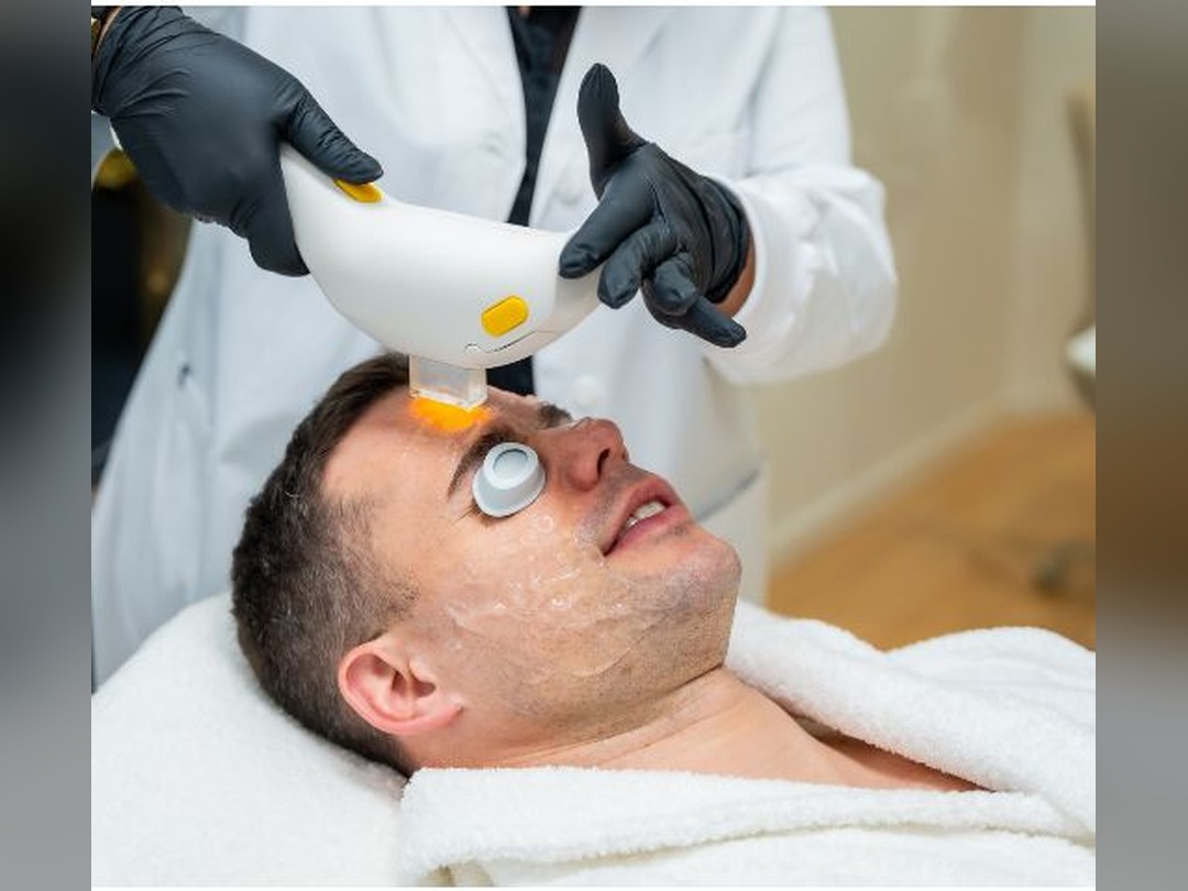 Photofacial IPL treatment on the face at Tu Es Belle Spa Houston