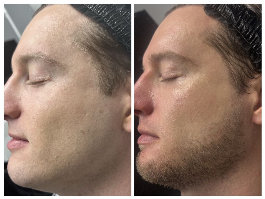 Men's before and after 4 sessions of CO2 skin resurfacing, IPL photofacial, oxygen bubble facial and microneedling with peptides at Tu Es Belle Spa in Houston Texas