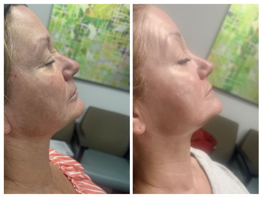 Before and after 4 sessions of CO2 skin resurfacing, oxygen bubble facial, microneedling with PDRN and exosomes and goji facial with cupping on face and neck at Tu Es Belle Spa in Houston Texas