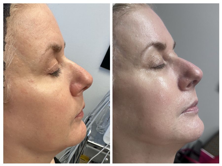 Before and after 4 sessions of chemical peel, microneedling with exosomes, high frequency with Epionce skincare and CO2 skin resurfacing at Tu Es Belle Spa in Houston Texas