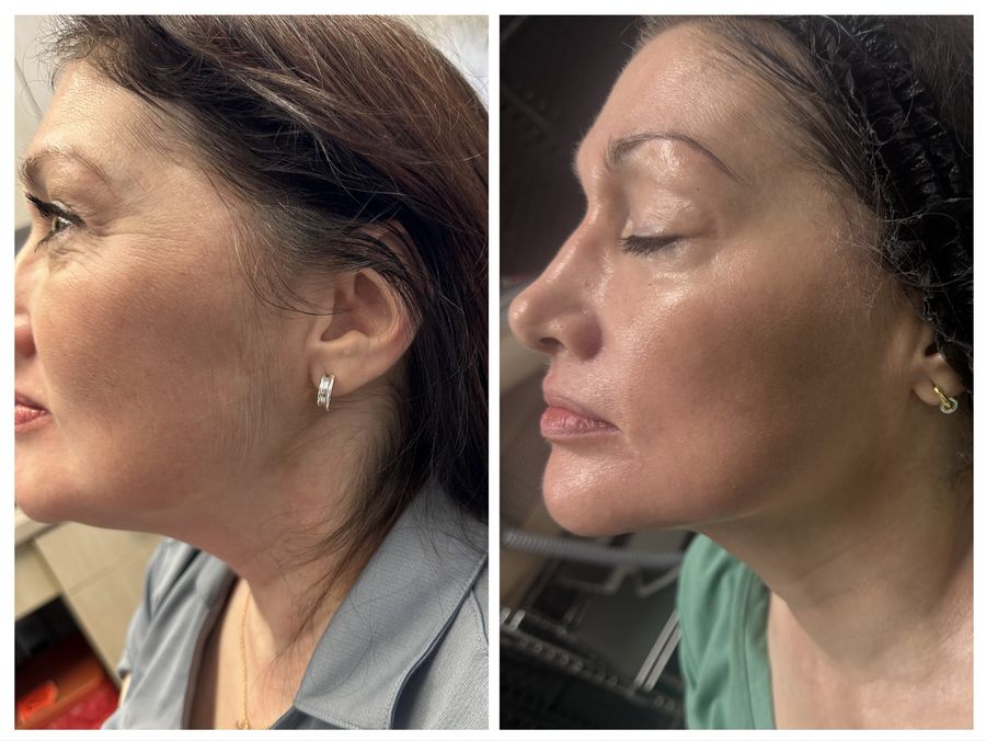 Before and after 4 sessions of CO2 skin resurfacing, microneedling with GHK-Cu copper peptide, BBGlow with hydra mask and Epionce Lux Facial at Tu Es Belle Spa in Houston Texas