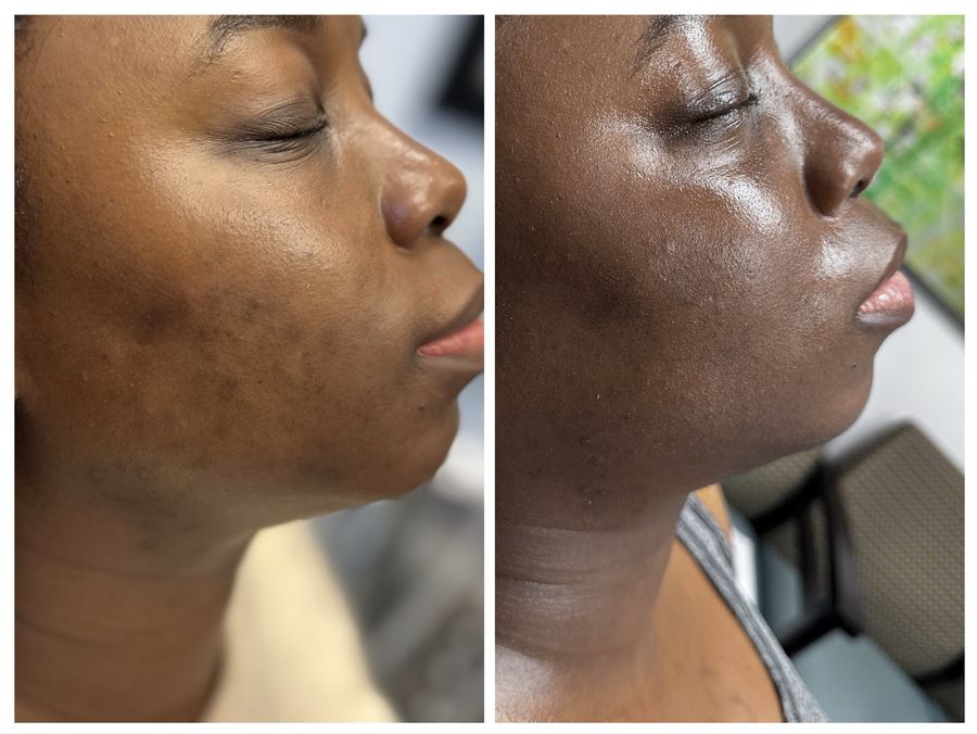 Before and after 3 sessions of chemical peel, microneedling with PDRN and high frequency facial with gua sha at Tu Es Belle Spa in Houston Texas