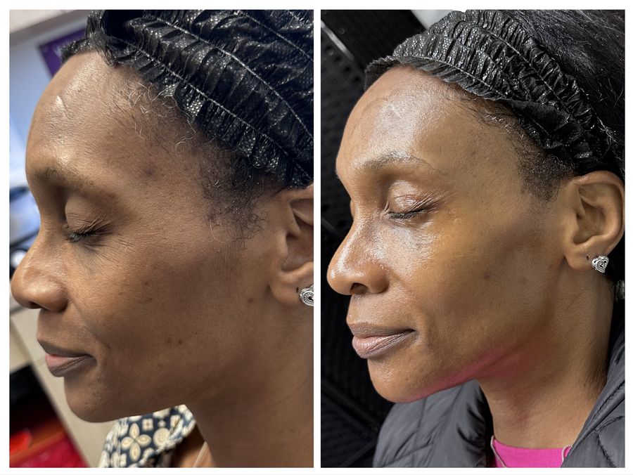Before and after 3 sessions of chemical peel, microneedling with PDRN and Epionce Lux Facial with cupping at Tu Es Belle Spa in Houston Texas