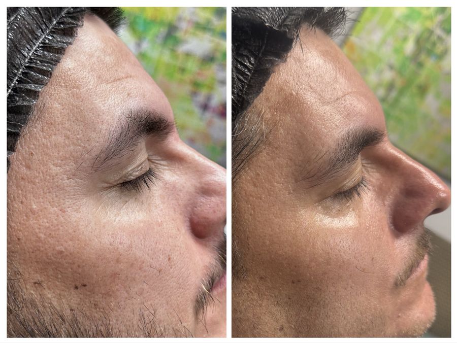 Before and after 4 sessions of chemical peel, microneedling with PDRN, oxygen bubble facial and hydrafacial with hot stones at Tu Es Belle Spa in Houston Texas