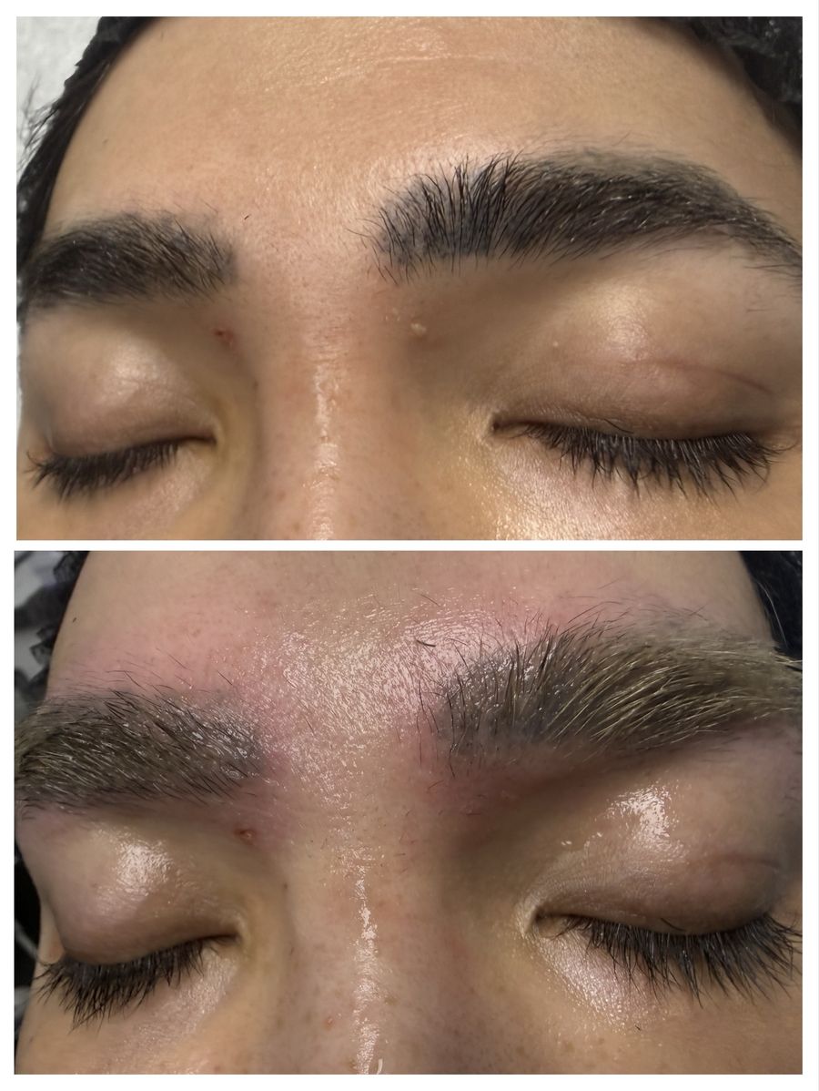 Eyebrow laser tattoo removal before and immediately after one session at Tu Es Belle Spa in Houston Texas